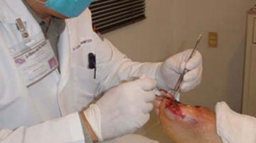 Aplicación del Heberprot-P