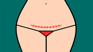 Mujer con cesárea